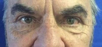 Blepharoplasty After Image