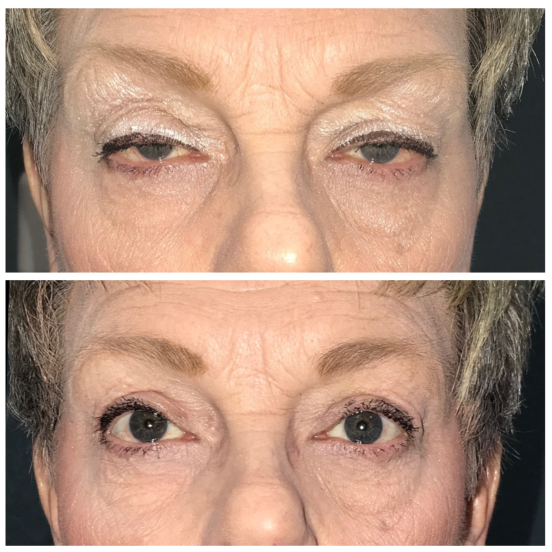 Ptosis Repair Before and Afters at Austin Face & Body