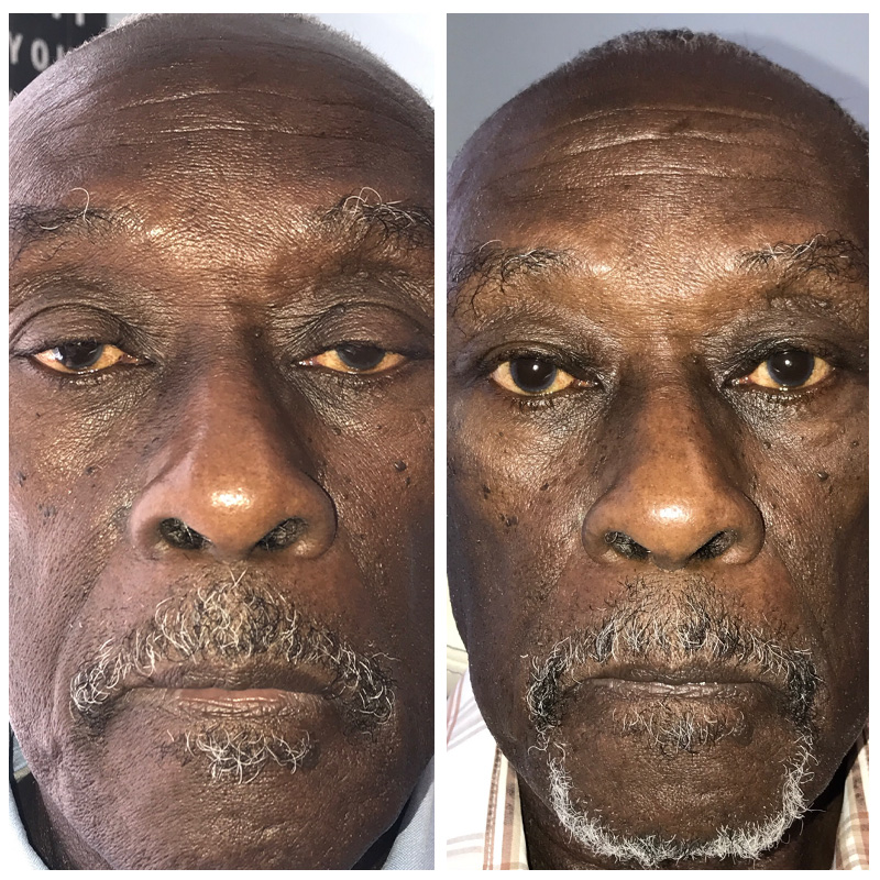 Ptosis Repair Before and Afters at Austin Face & Body