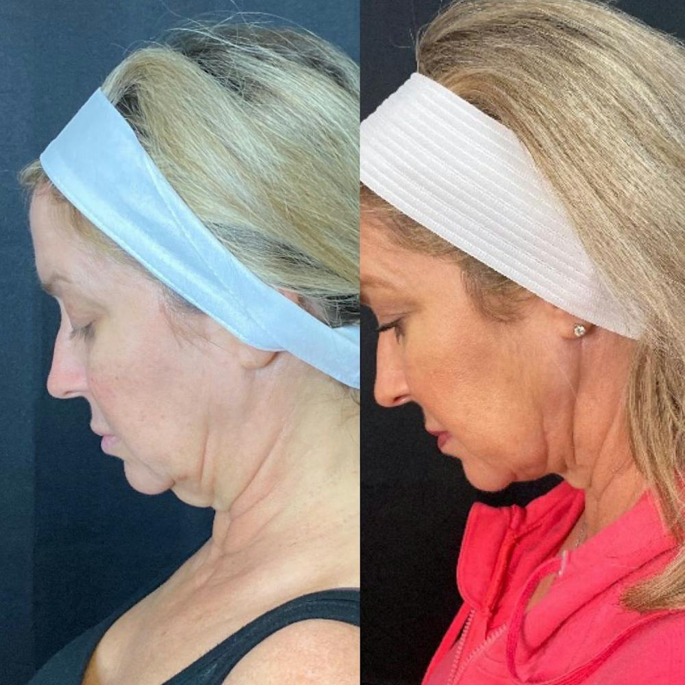 Before & after FaceTite at Austin Face & Body