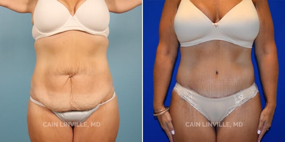 Tummy Tuck Austin  Abdominoplasty in Austin