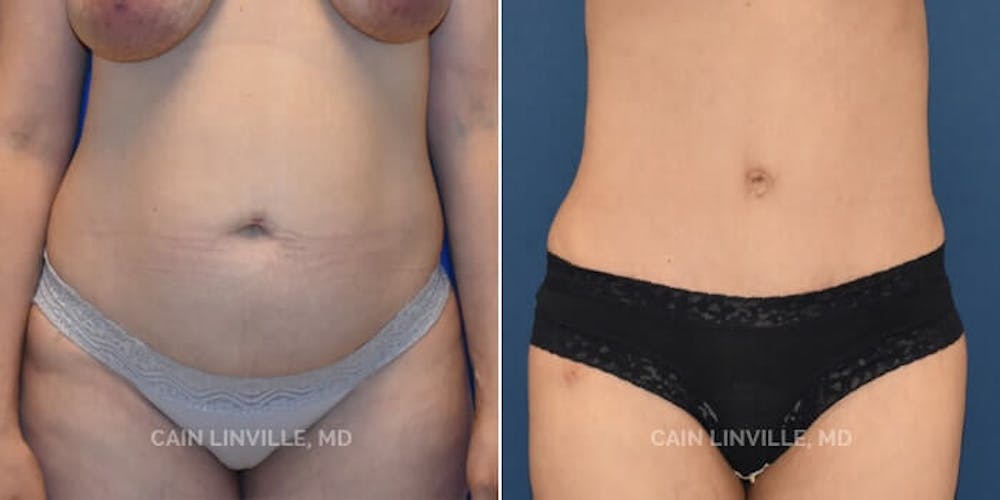Tummy Tuck results at Austin Face & Body