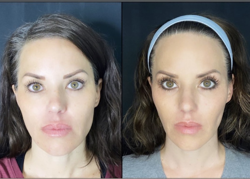 Evoke Face and Neck Contouring – DR. MARIE
