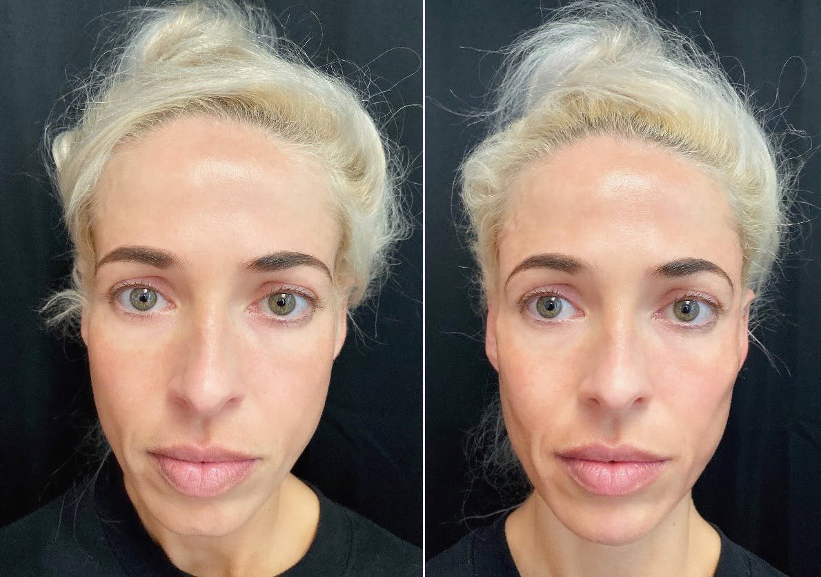 Dermal Fillers Before & After Photos with Ali Patek Austin Face & Body