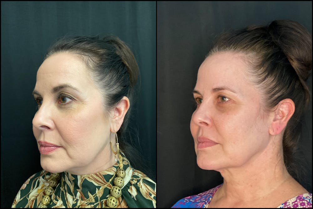 Before & after FaceTite at Austin Face & Body
