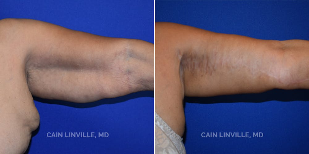 Arm Lift Before & After Gallery - Patient 8522137 - Image 1