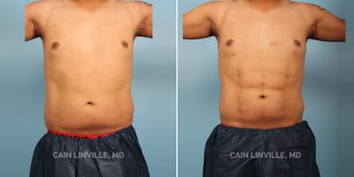 Body Etching (High-Def Lipo) Before & After Gallery - Patient 8522158 - Image 1