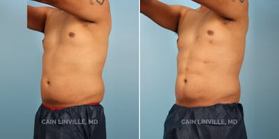 Body Etching (High-Def Lipo) Before & After Gallery - Patient 8522158 - Image 2