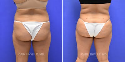 Brazilian Butt Lift (BBL) Before & After Gallery - Patient 8522172 - Image 1