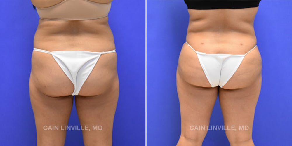 Brazilian Butt Lift (BBL) Before & After Gallery - Patient 8522172 - Image 1