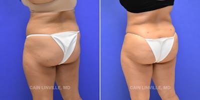 Brazilian Butt Lift (BBL) Before & After Gallery - Patient 8522172 - Image 2
