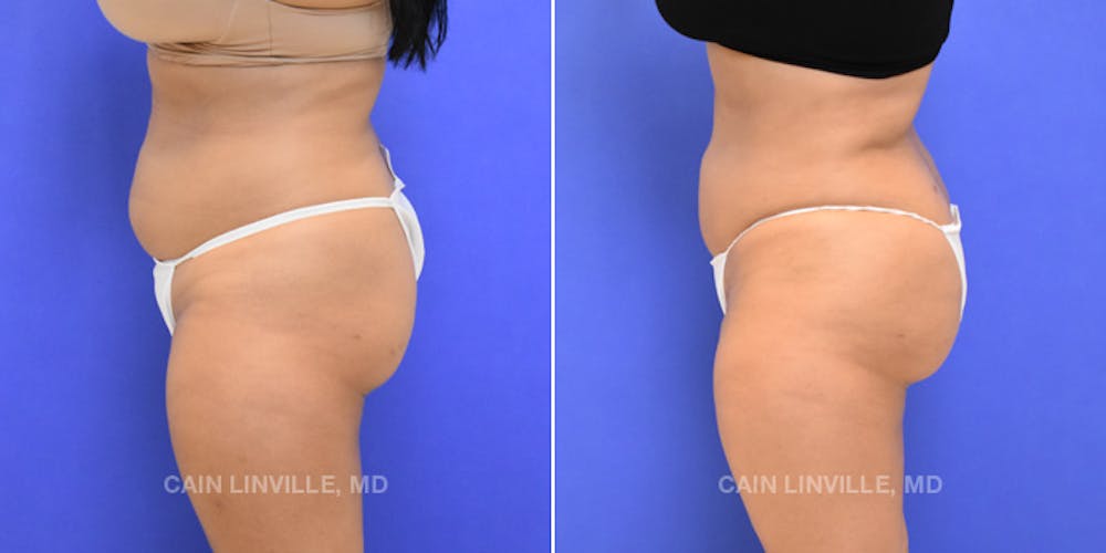 Brazilian Butt Lift (BBL) Before & After Gallery - Patient 8522172 - Image 3