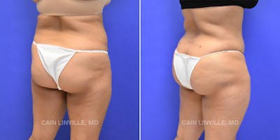 Brazilian Butt Lift (BBL) Before & After Gallery - Patient 8522172 - Image 4