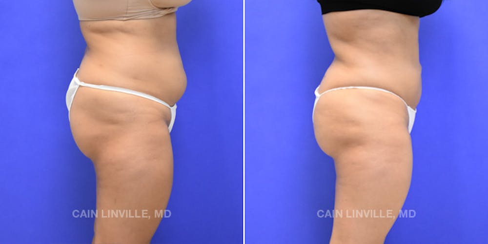 Brazilian Butt Lift (BBL) Before & After Gallery - Patient 8522172 - Image 5