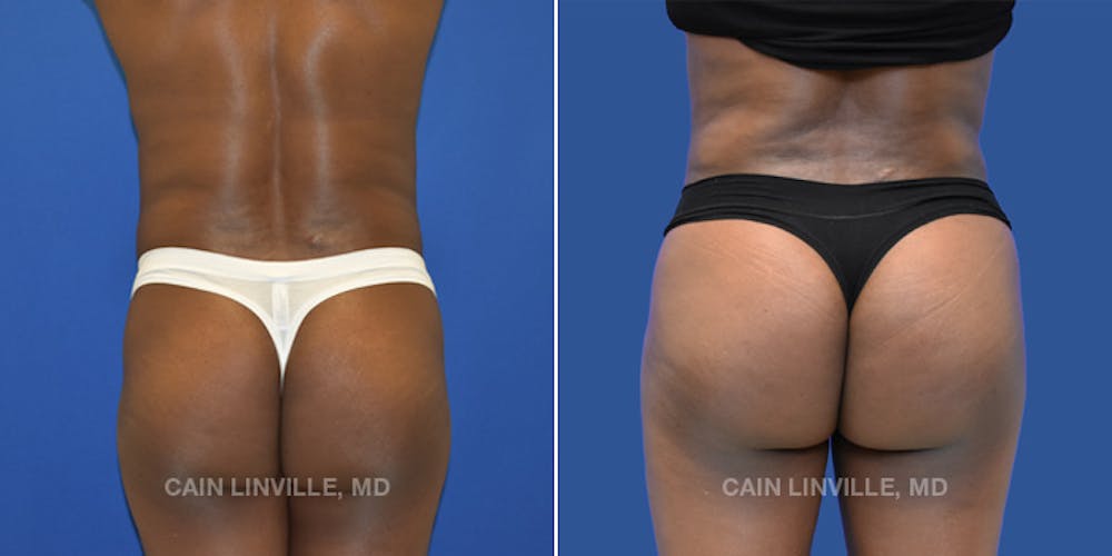 Brazilian Butt Lift (BBL) Before & After Gallery - Patient 8522182 - Image 1