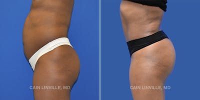 Brazilian Butt Lift (BBL) Before & After Gallery - Patient 8522182 - Image 2