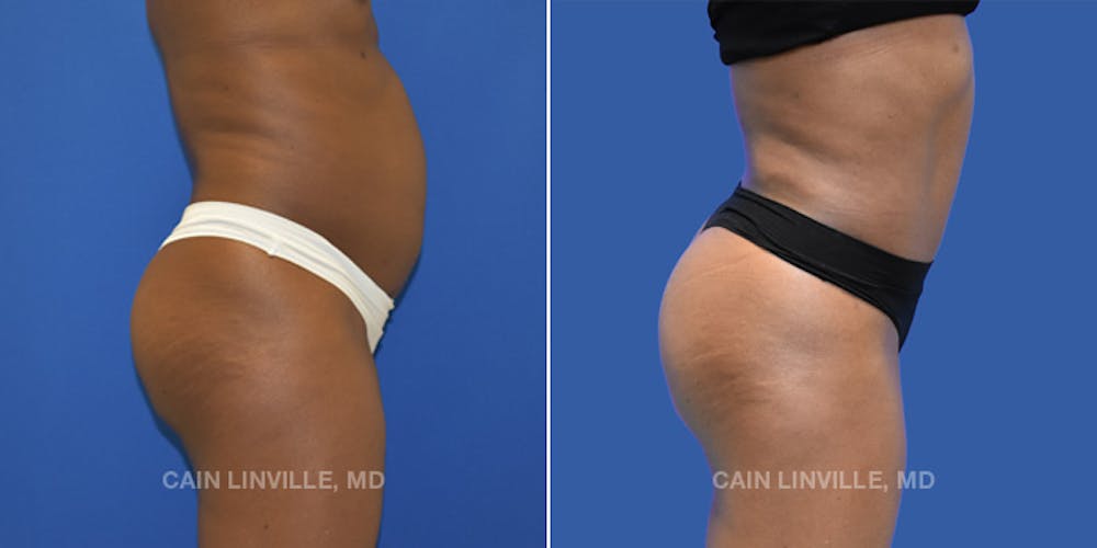 Brazilian Butt Lift (BBL) Before & After Gallery - Patient 8522182 - Image 3