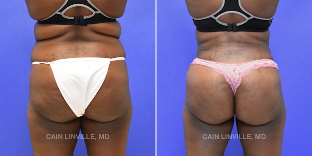 Brazilian Butt Lift (BBL) Before & After Gallery - Patient 8522196 - Image 1