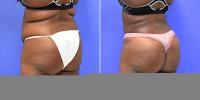 Brazilian Butt Lift (BBL) Before & After Gallery - Patient 8522196 - Image 2