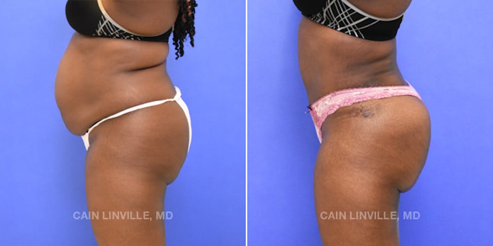 Brazilian Butt Lift (BBL) Before & After Gallery - Patient 8522196 - Image 3