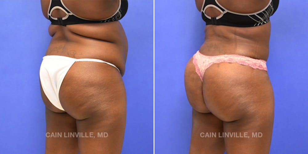 Patient 8522196, Brazilian Butt Lift (BBL) Before & After Photos