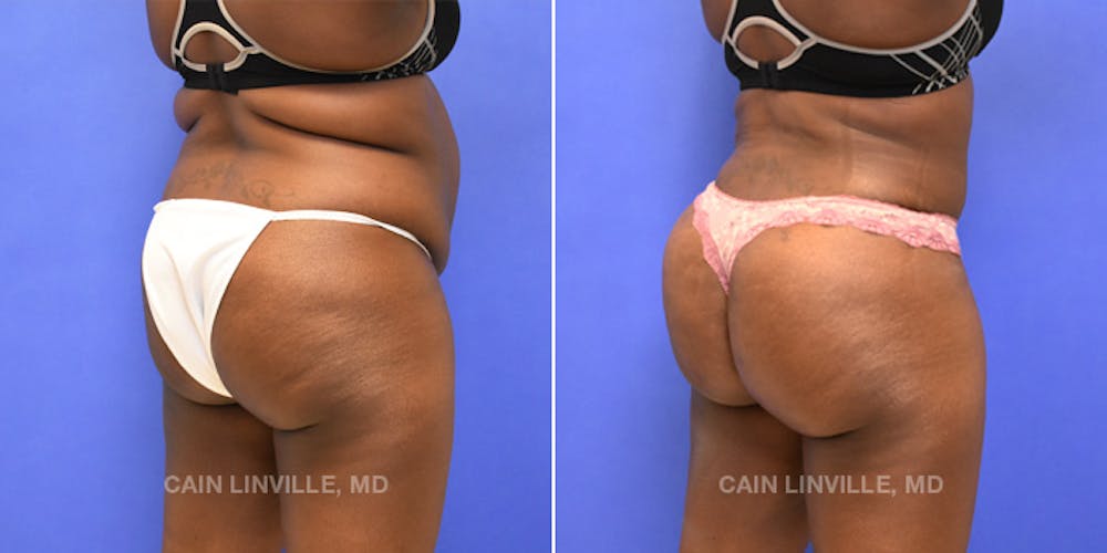Brazilian Butt Lift (BBL) Before & After Gallery - Patient 8522196 - Image 4