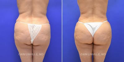 Brazilian Butt Lift (BBL) Before & After Gallery - Patient 8522206 - Image 1