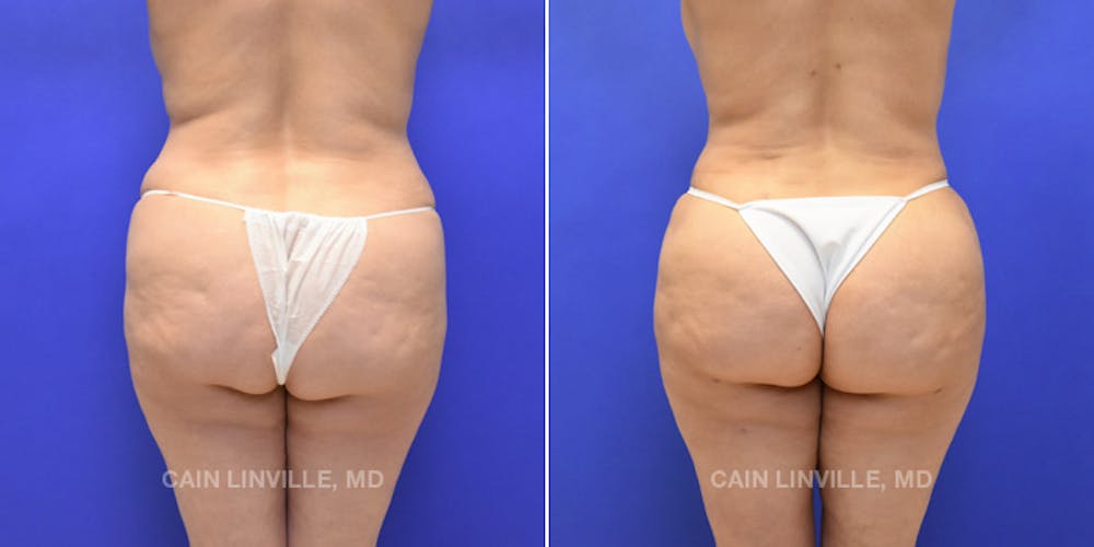Brazilian Butt Lift (BBL) Before & After Gallery - Patient 8522206 - Image 1