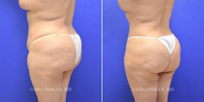 Brazilian Butt Lift (BBL) Before & After Gallery - Patient 8522206 - Image 2