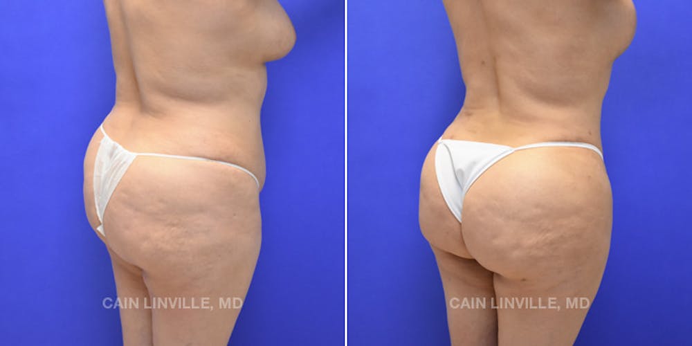 Brazilian Butt Lift (BBL) Before & After Gallery - Patient 8522206 - Image 3