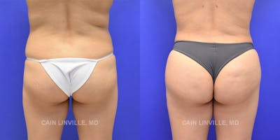 Brazilian Butt Lift (BBL) Before & After Gallery - Patient 8522215 - Image 1