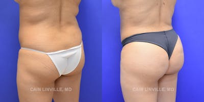 Brazilian Butt Lift (BBL) Before & After Gallery - Patient 8522215 - Image 2