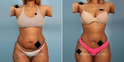 Mini Tummy Tuck Before & After Gallery - Patient 8522238 - Image 1