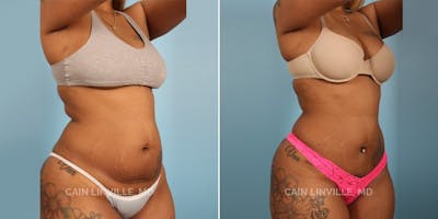 Mini Tummy Tuck Before & After Gallery - Patient 8522238 - Image 2