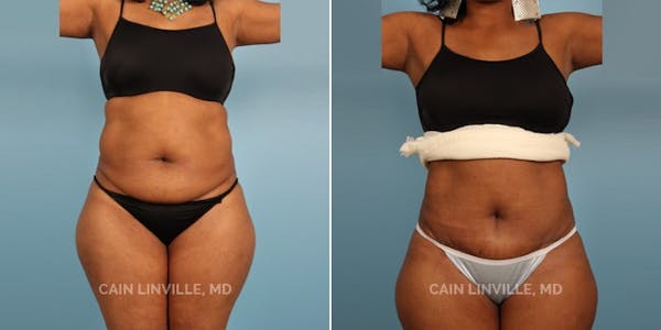 Mini Tummy Tuck Before & After Gallery - Patient 8522251 - Image 1