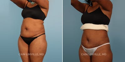 Mini Tummy Tuck Before & After Gallery - Patient 8522251 - Image 2