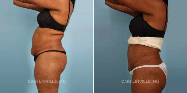 Mini Tummy Tuck Before & After Gallery - Patient 8522251 - Image 3