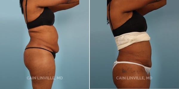 Mini Tummy Tuck Before & After Gallery - Patient 8522251 - Image 4