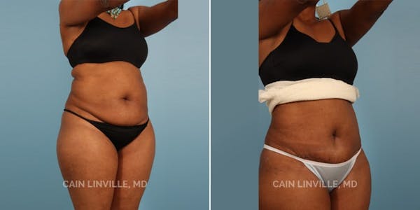 Mini Tummy Tuck Before & After Gallery - Patient 8522251 - Image 5