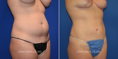 Mini Tummy Tuck Before & After Gallery - Patient 8522257 - Image 1