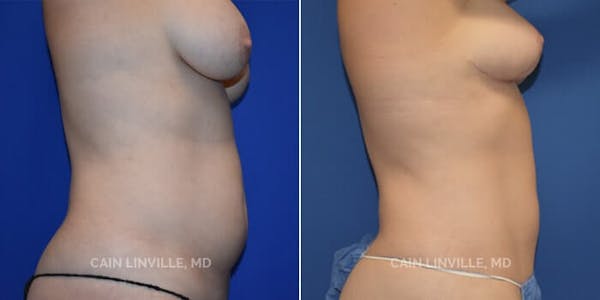 Mini Tummy Tuck Before & After Gallery - Patient 8522257 - Image 2