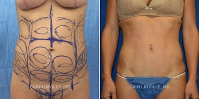 Mini Tummy Tuck Before & After Gallery - Patient 8522274 - Image 1