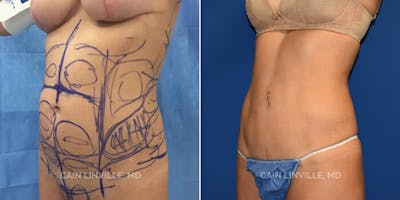 Mini Tummy Tuck Before & After Gallery - Patient 8522274 - Image 2