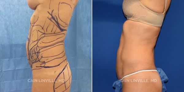 Mini Tummy Tuck Before & After Gallery - Patient 8522274 - Image 3