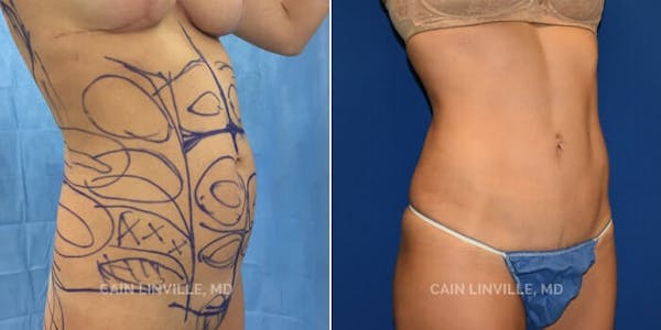 Mini Tummy Tuck Before & After Gallery - Patient 8522274 - Image 4