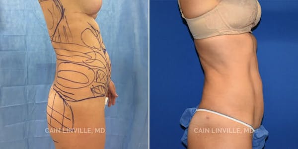 Mini Tummy Tuck Before & After Gallery - Patient 8522274 - Image 5