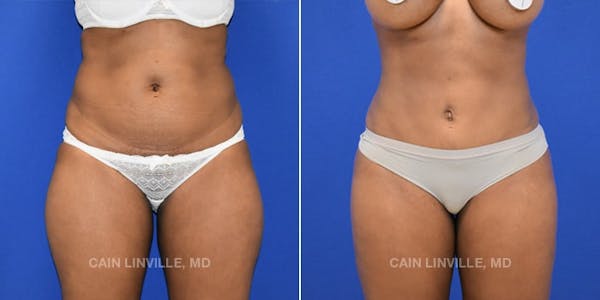 Mini Tummy Tuck Before & After Gallery - Patient 8522289 - Image 1