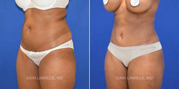 Mini Tummy Tuck Before & After Gallery - Patient 8522289 - Image 2