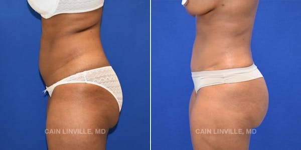 Mini Tummy Tuck Before & After Gallery - Patient 8522289 - Image 3