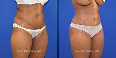 Mini Tummy Tuck Before & After Gallery - Patient 8522289 - Image 4